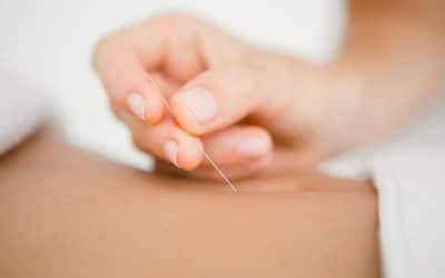 Dry Needling