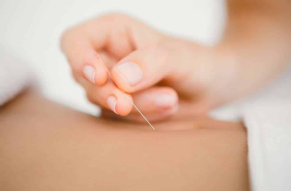 Dry Needling